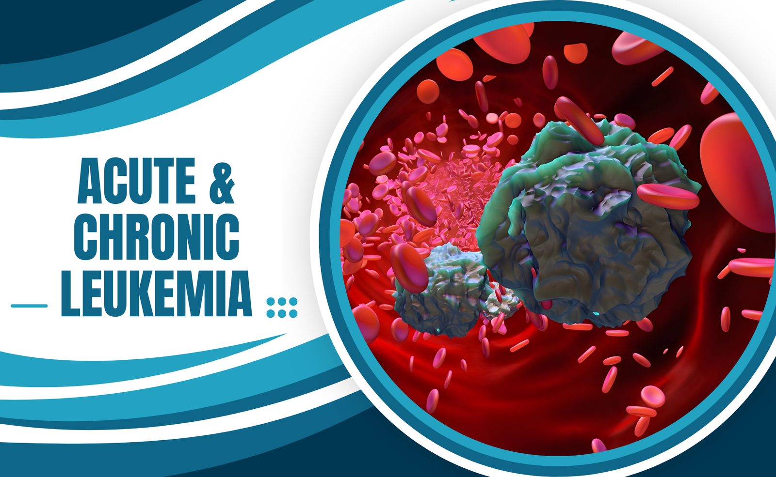 Acute & Chronic Leukemia